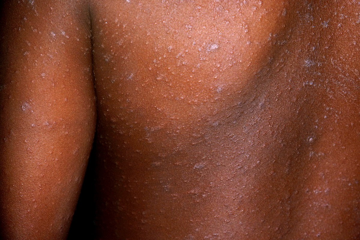 Lesotho remains vulnerable to measles, rubella outbreak Lesotho remains vulnerable to measles, rubella outbreak