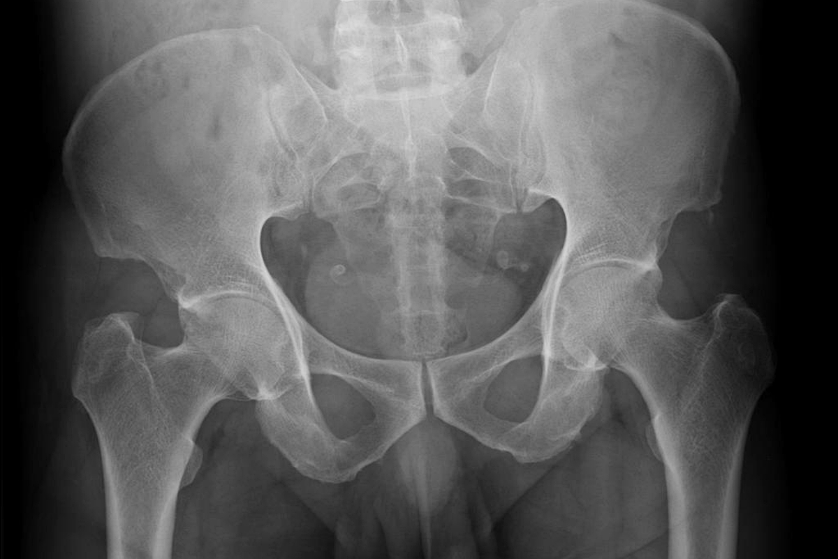 Calcifications Calcifications