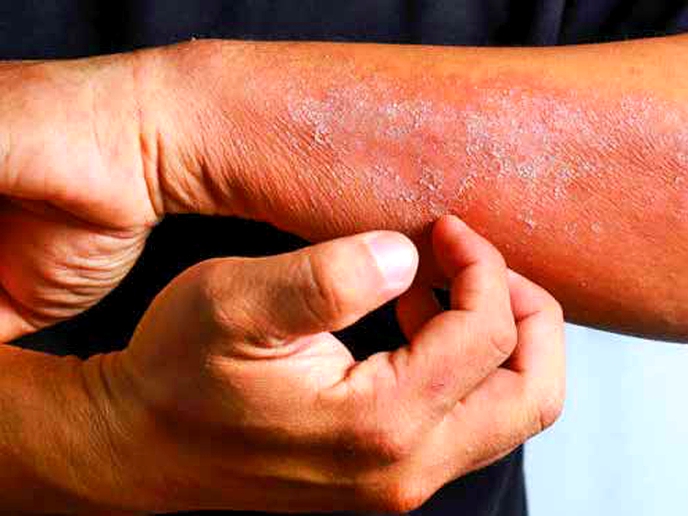 Prevent and treat common spring rashes