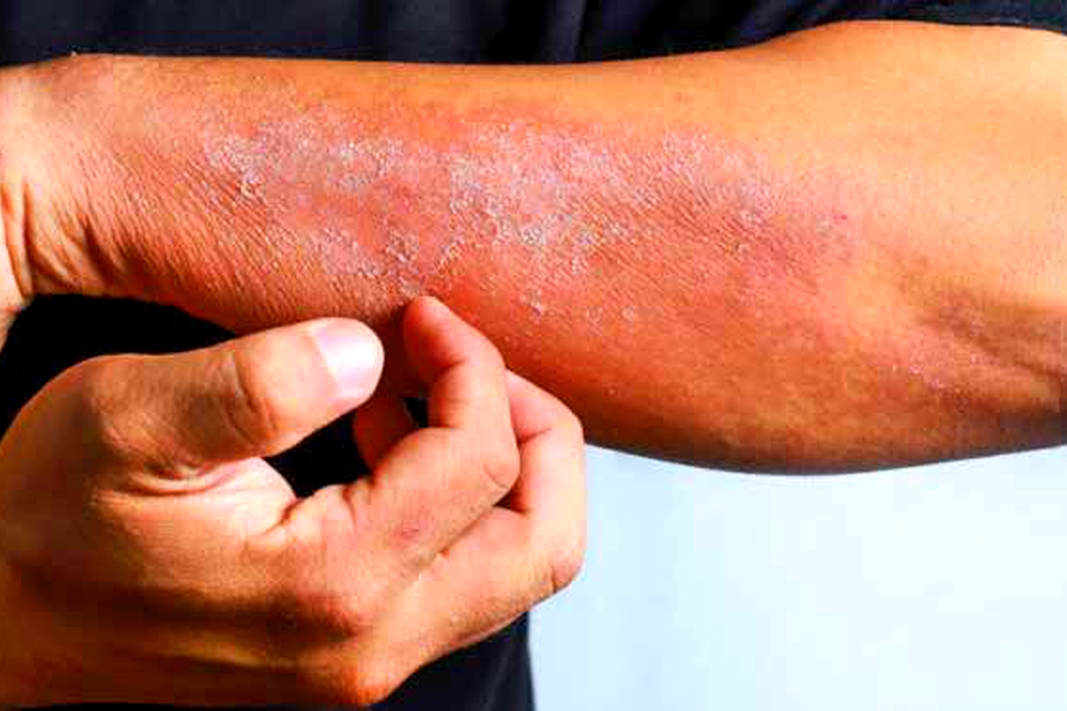 Prevent and treat common spring rashes