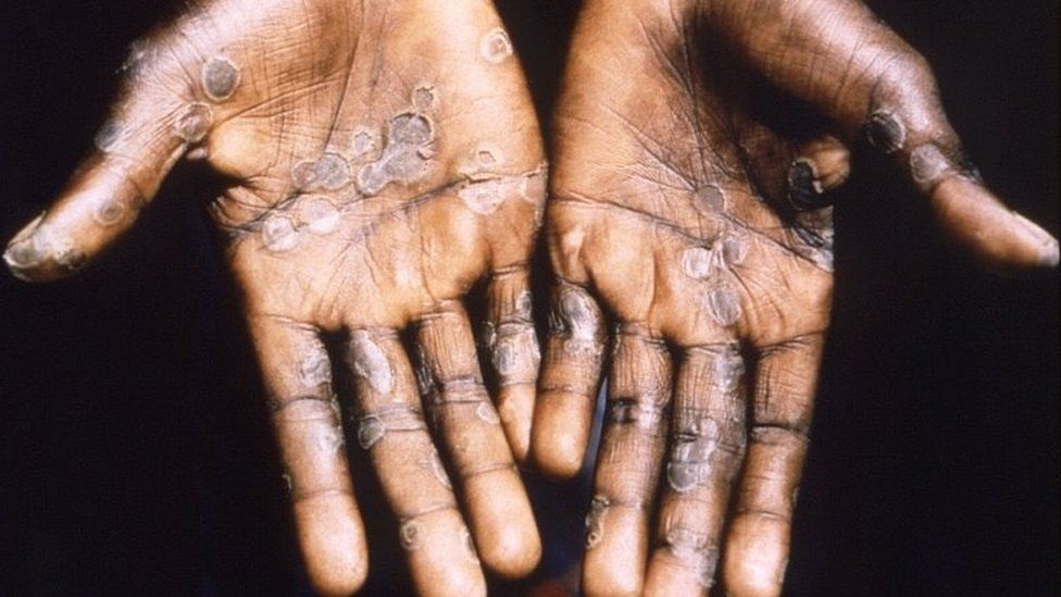 World faces big challenges over Covid, monkeypox and wars – WHO