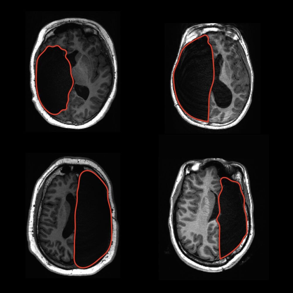 Word and face recognition can be adequately supported with half a brain